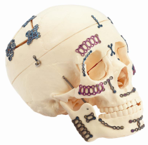 Skull model showing typical (metal) boneplates used in maxillofacial surgery repairs to assist fracture healing